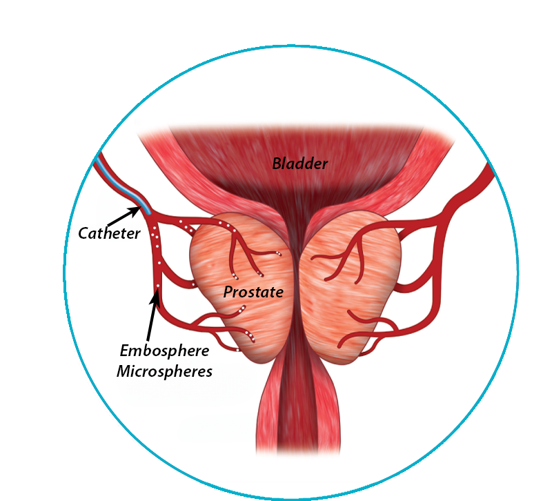 Embolization